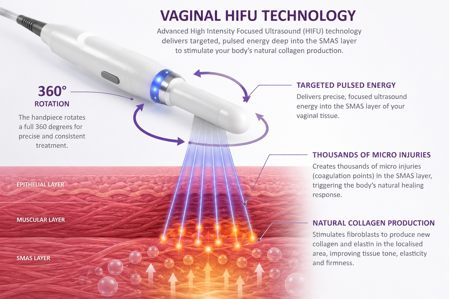 Diagram of vaginal HIFU technology: 360-degree rotating handpiece delivering focused ultrasound energy into the SMAS layer to stimulate collagen production